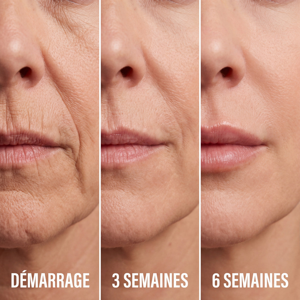 Contour de la bouche : démarrage, 3 semaines, 6 semaines